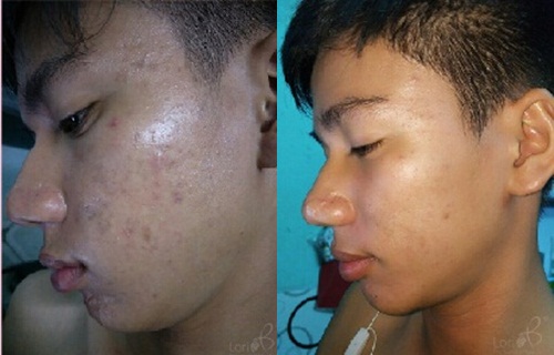 Thương hiệu Lori B thực hiện chương trình trị mụn miễn phí mỗi tháng