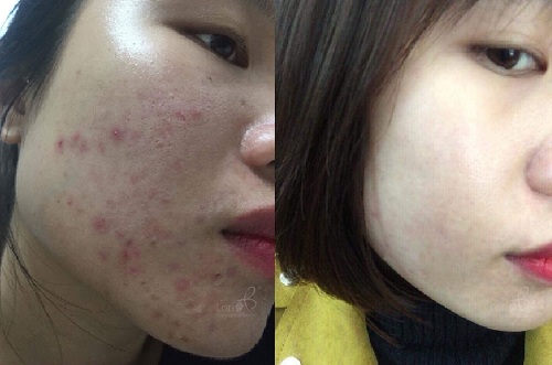 Thương hiệu Lori B thực hiện chương trình trị mụn miễn phí mỗi tháng